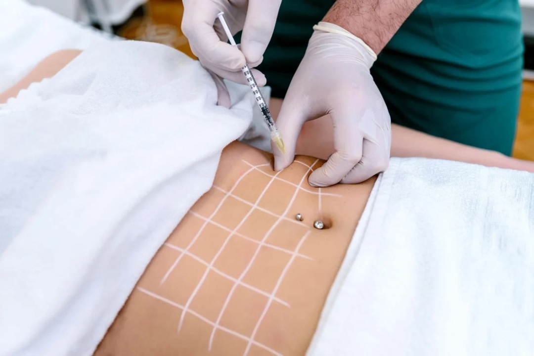 Woman's having lipolysis treatment 